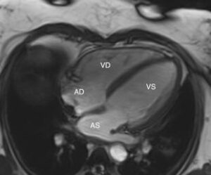 La Risonanza Magnetica Cardiaca