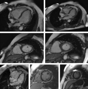 La Risonanza Magnetica Cardiaca