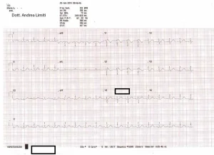 Sindrome di Brugada