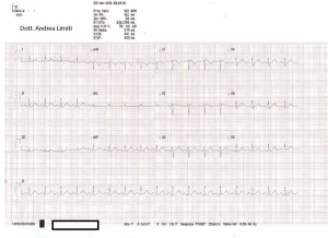 Sindrome di Brugada